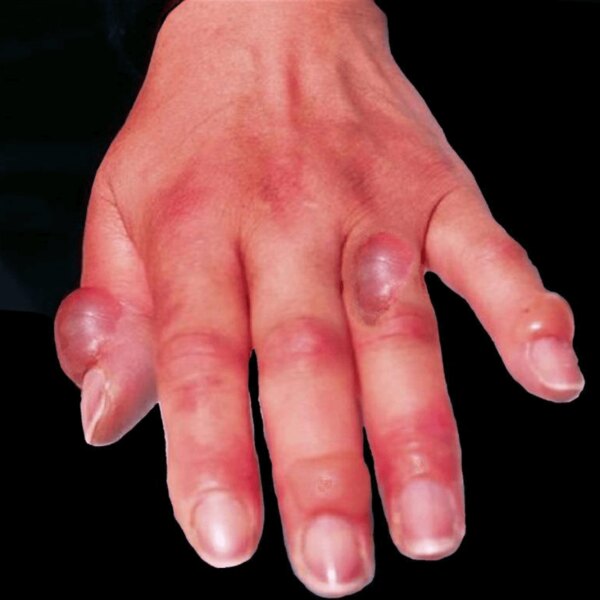 Omrzliny druhého stupňa: pľuzgiere s čírym obsahom a znížená citlivosť v postihnutej oblasti. Foto: https://commons.wikimedia.org/wiki/File:Hand_frostbite.jpg